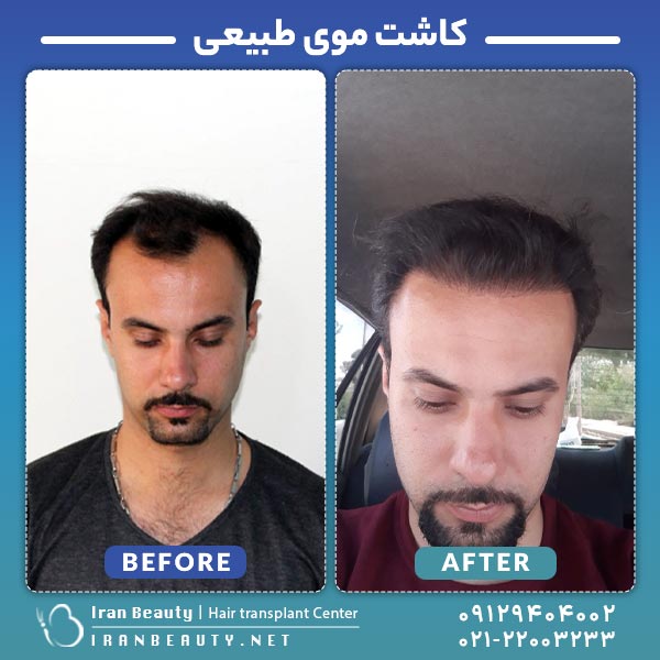 قبل و بعد از کاشت مو به روش SUPER FUE