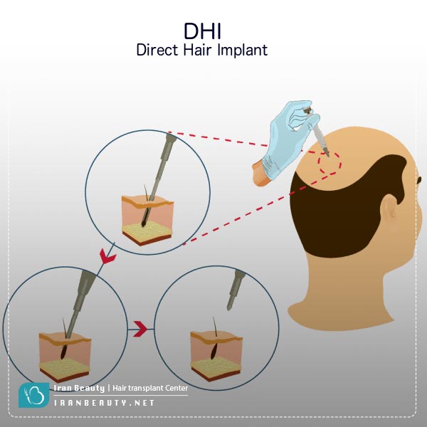 مراحل کاشت مو به روش DHI