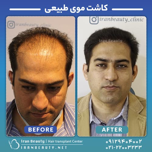 قبل و بعد از کاشت مو به روش FIT