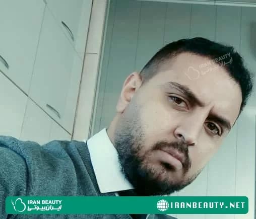 نتیجه کاشت موی طبیعی