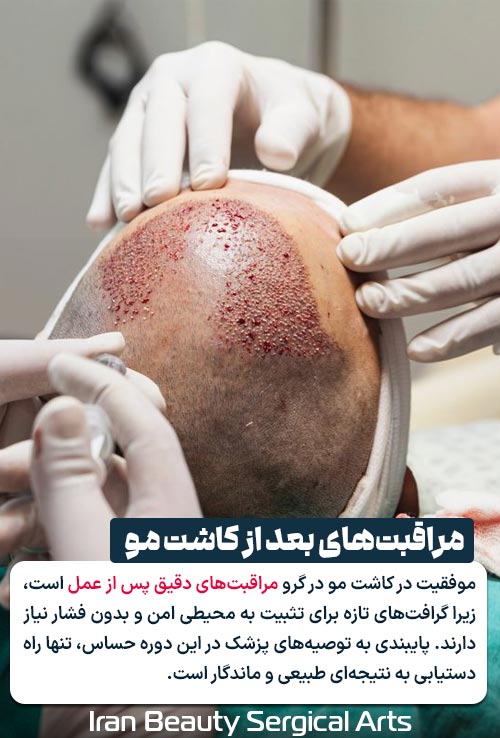 مراقبت های بعد از کاشت مو