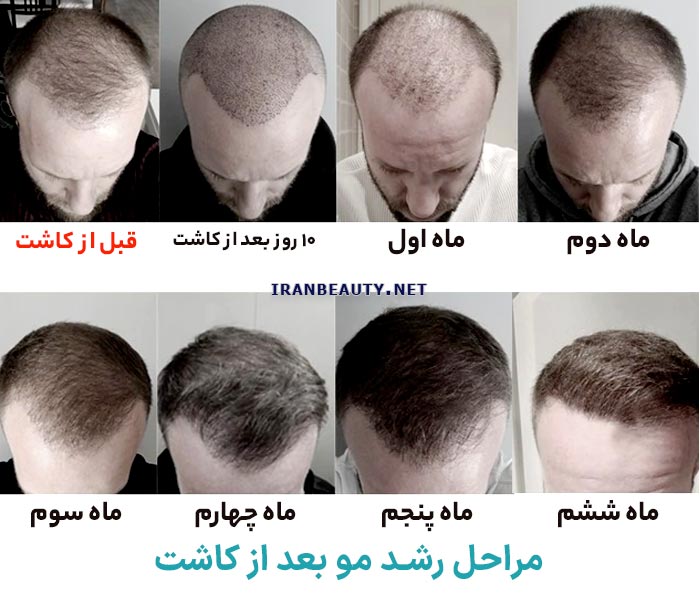 مراحل رشد موها در ۶ ماهه اول بعد از کاشت مو