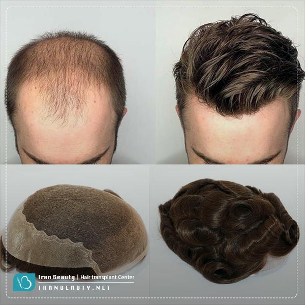 قبل و بعد از پروتز مو