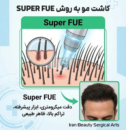کاشت مو به روش SUPER FUE