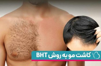 کاشت مو به روش BHT