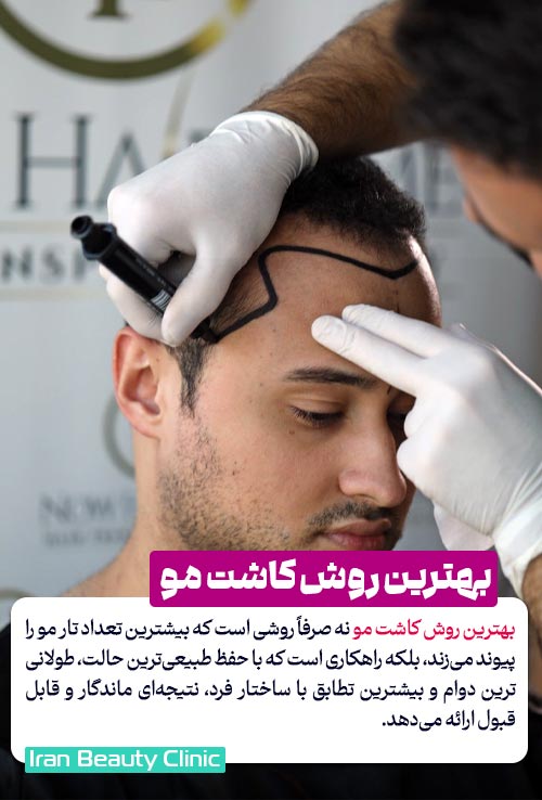 بهترین روش کاشت مو
