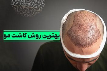 بهترین روش کاشت مو چیست