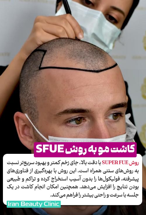 کاشت مو به روش SUPER FUE