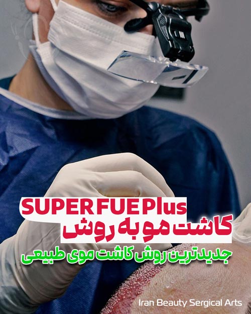 کاشت مو به روش Super fue