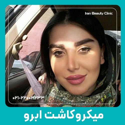 نتیجه نهایی میکروکاشت ابرو