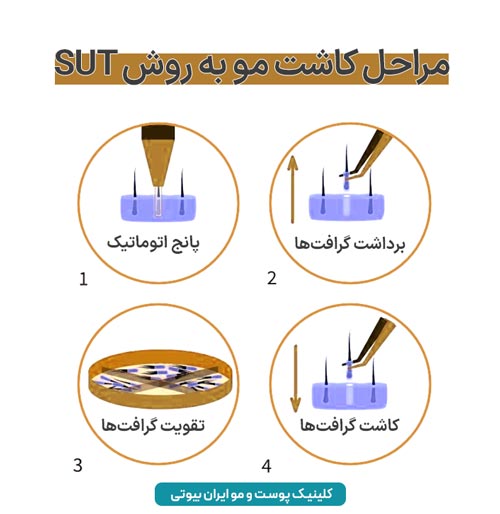 مراحل کاشت مو به روش SUT