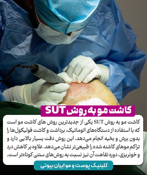 تصویر برداشت گرافت های مو در کاشت مو به روش SUT 