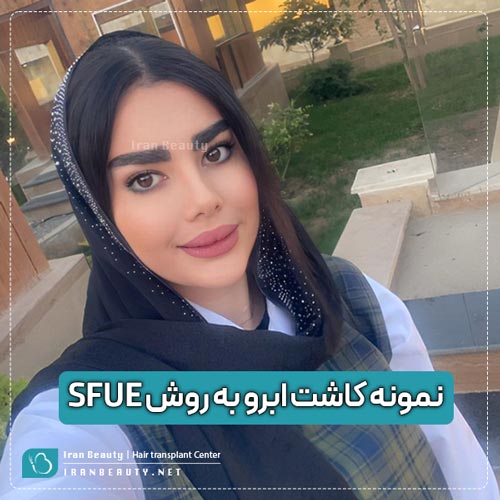 نمونه کاشت ابرو به روش sfue