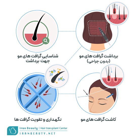 مراحل کاشت ابروی طبیعی