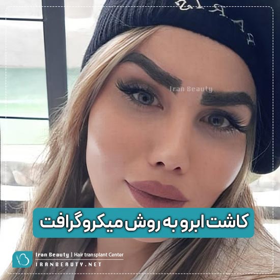 نمونه کاشت ابرو به روش میکروگرافت