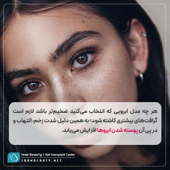 پوسته پوسته شدن ابروها بعد از کاشت