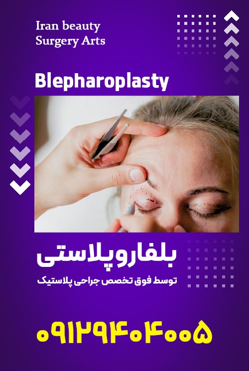 بلفاروپلاستی توسط فوق تخصص جراحی پلاستیک