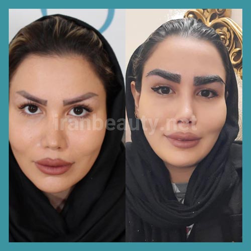 قبل و بعد از کاشت ابرو بدون جراحی