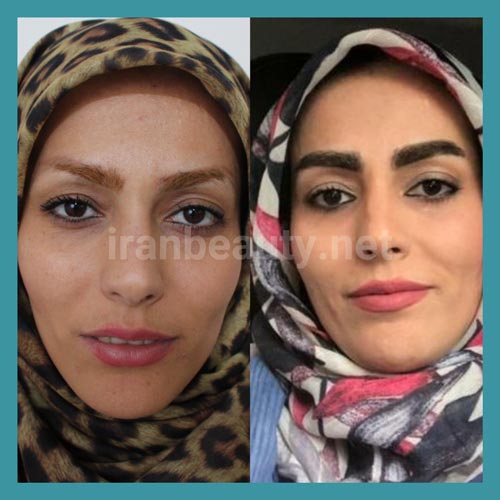 کاشت ابرو به روش میکروکاشت