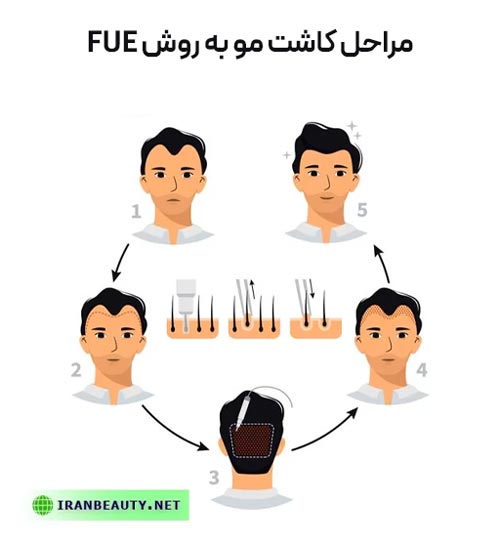 مراحل کاشت مو به روش FUE
