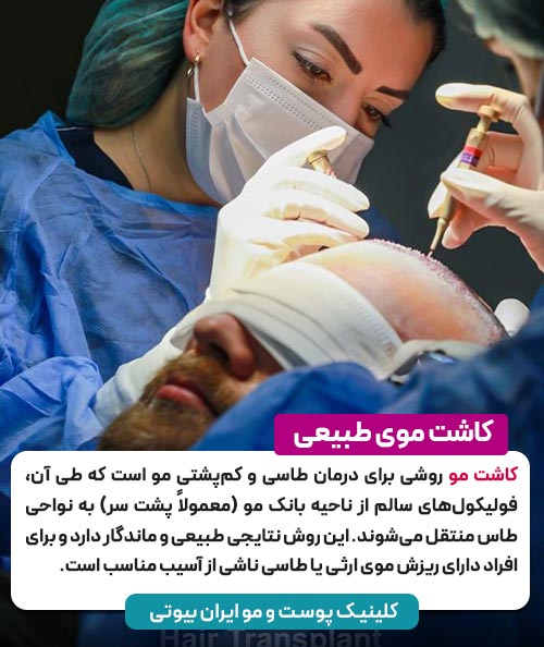 کاشت مو چیست