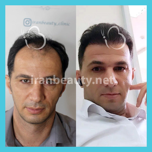 تصویر قبل و بعد از کاشت موی به روش SUPER FUE Plus