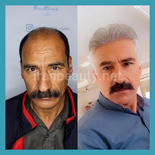 تصویر قبل و بعد از کاشت موی به روش میکروگرافت