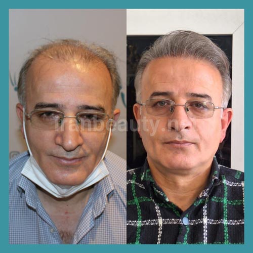 تصویر قبل و بعد از کاشت موی به روش سوپر ترکیبی