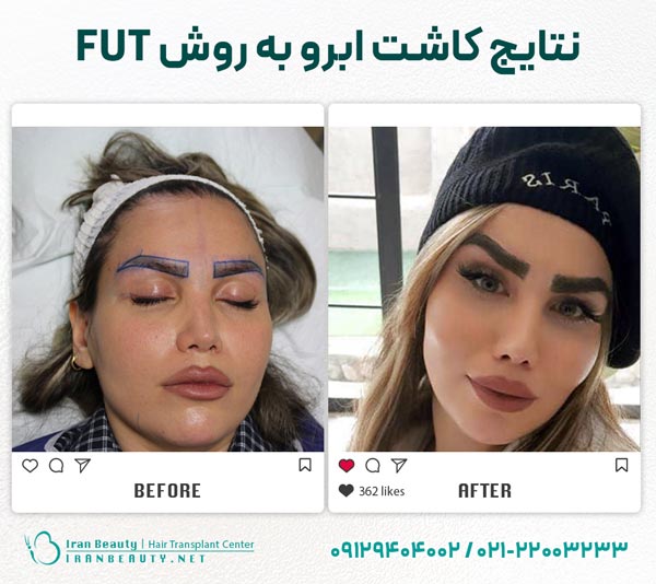 قبل و بعد از کاشت ابرو به روش FUT