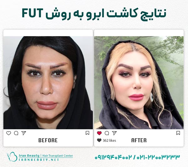 نتیجه کاشت ابروی طبیعی به روش FUT