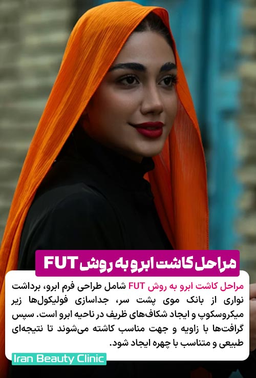 مراحل کاشت ابرو به روش FUT