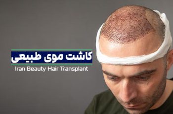 کاشت موی طبیعی