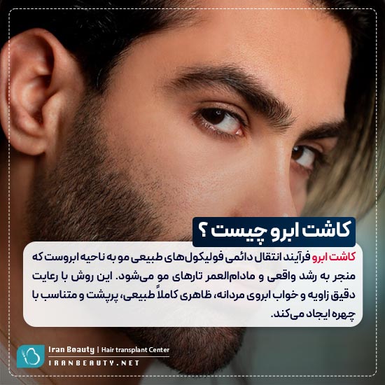 کاشت ابرو مردانه