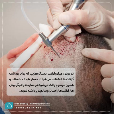 برداشت مو در روش میکروگرافت