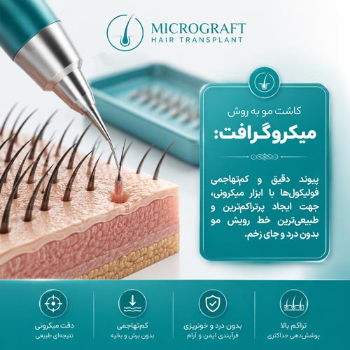 کاشت مو به روش میکروگرافت