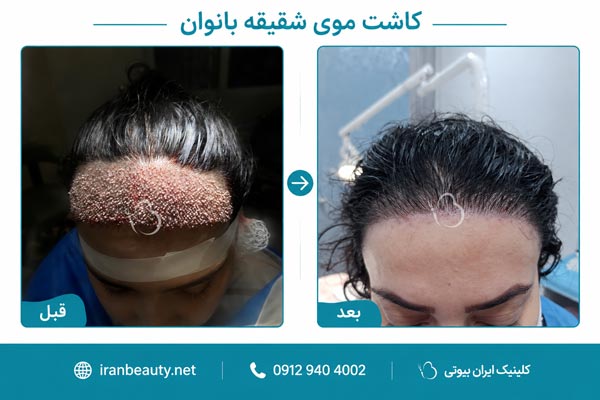قبل و بعد از کاشت موی شقیقه بانوان