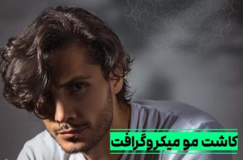کاشت مو به روش میکروگرافت