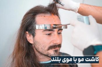 کاشت مو با موی بلند