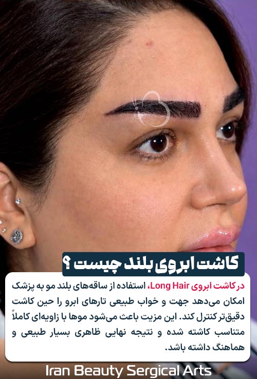 کاشت ابروی بلند