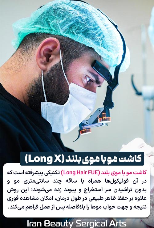 کاشت مو با موی بلند
