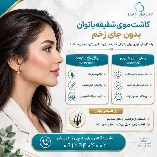 کاشت موی شقیقه خانم ها