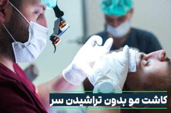 کاشت مو بدون تراشیدن سر