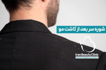 علت و نحوه درمان شوره سر بعد از کاشت مو